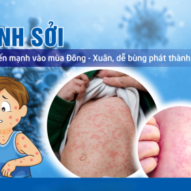Dịch sởi bùng phát lan rộng và những điều cần biết
