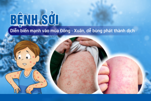 Dịch sởi bùng phát lan rộng và những điều cần biết