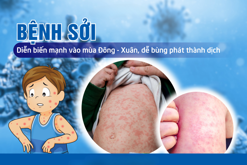 Dịch sởi bùng phát lan rộng và những điều cần biết