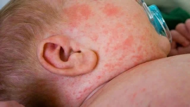 Dịch sởi bùng phát lan rộng và những điều cần biết