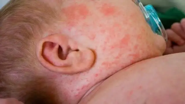 Cảnh báo dịch sởi lan rộng, và những điều bạn cần biết Dịch sởi bùng phát lan rộng và những điều cần biết