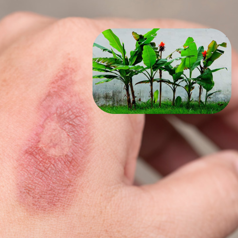 tri-bong-nhe-tai-nha-bang-mu-chuoi-hot