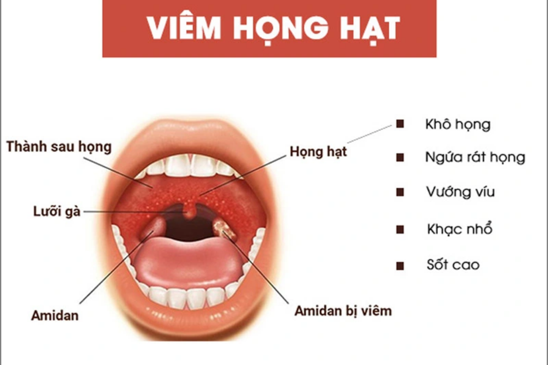 Đừng Chủ Quan Với Viêm Họng Hạt: Nguyên Nhân "Ẩn Giấu" Khiến Bệnh Dai Dẳng viem hong hat 2