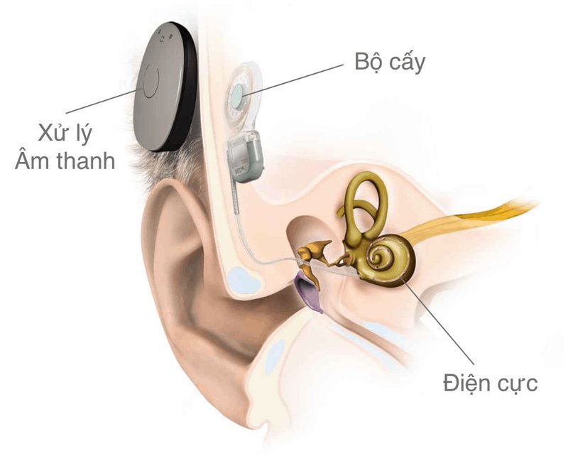 Cấy ốc tai điện tử trong điều trị đột quỵ ốc tai