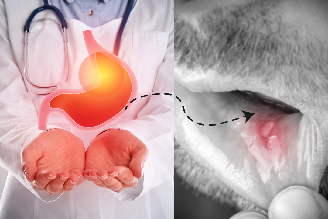 Nhiệt miệng tái phát? Bạn có chăm sóc răng miệng đúng cách? trao nguoc da day gay nhiet mieng