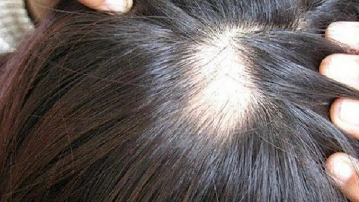 Tóc rụng nhiều khi căng thẳng phải làm sao? Giải pháp phục hồi tóc hiệu quả và an toàn toc rung nhieu khi cang thang khien da dau lo ro