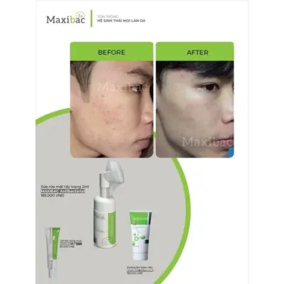 Kem dưỡng ẩm Maxibac Glycerin cho da dầu mụn, nhạy cảm, lọ 50ml Phan-hoi-ve-kem-duong-am-maxibac-glycerin